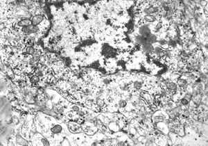 F,4y. | retroperitoneal neuroblastoma F,4y. | retroperitoneal neuroblastoma